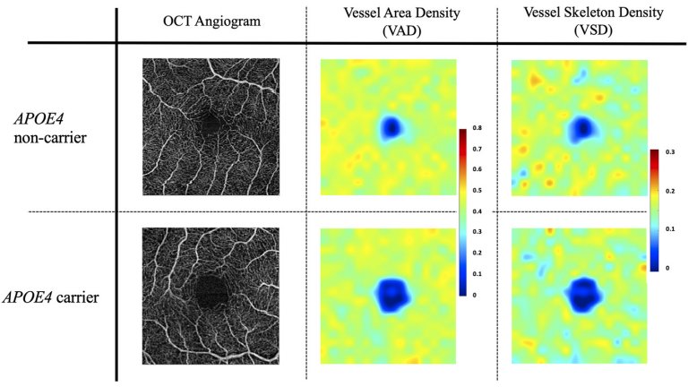 Exame ocular mostra indcios do mal de Alzheimer