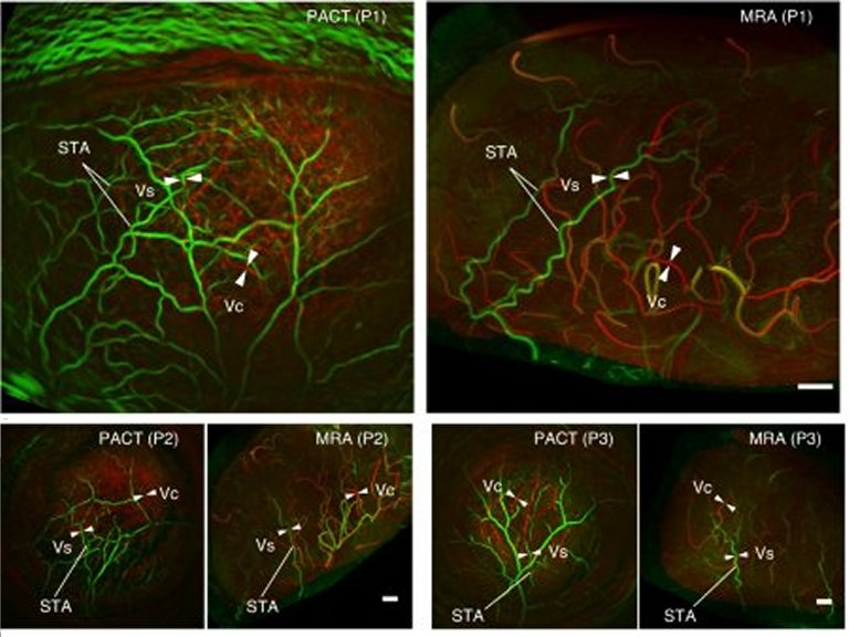 Tcnica com laser e ultrassom produz melhores imagens do crebro em 3D