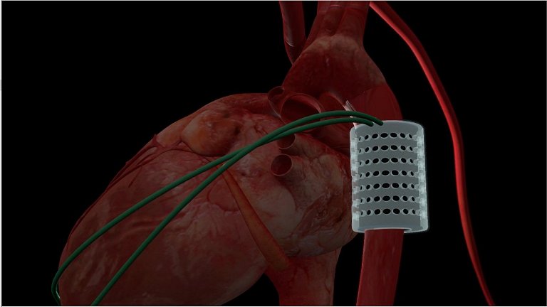 Músculo cardíaco artificial dispensa peças metálicas