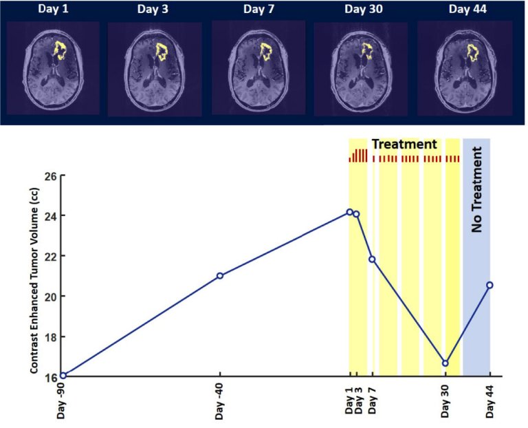 Terapia magnética reduz câncer do cérebro em um mês