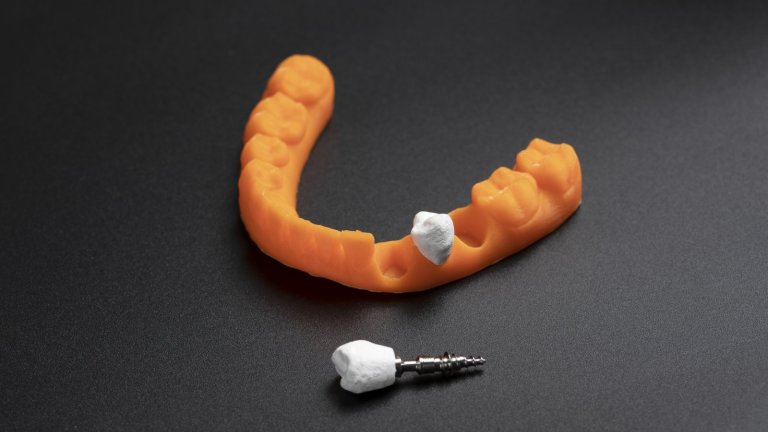 Implante dentário bioinspirado é feito com celulose