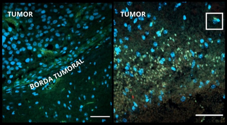 Injeções de vírus zika interrompem câncer cerebral em cobaias