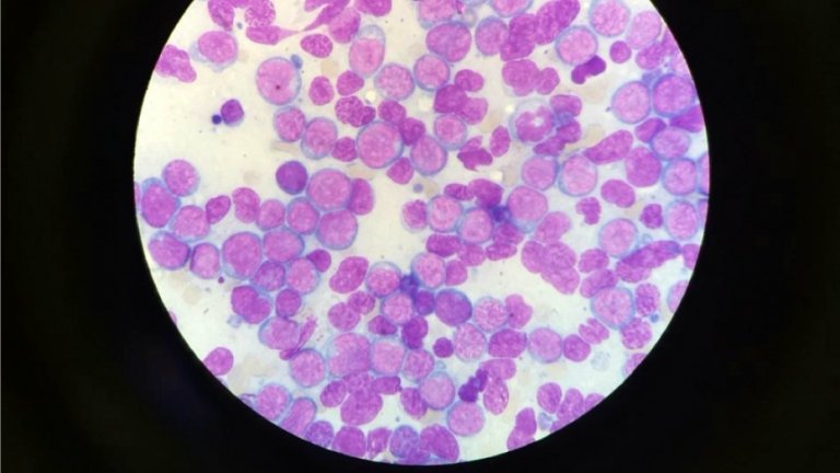 Descobertas mutações genéticas que desencadeiam leucemia aguda grave