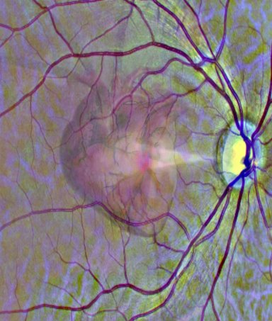 Inteligência Artificial calcula risco de infarto analisando imagens da retina