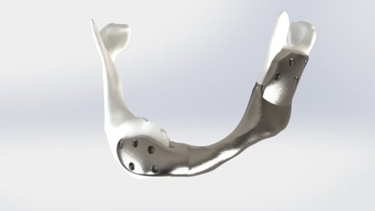 Implante titnio impresso 3D