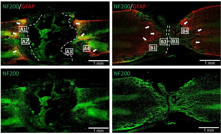 Reparo de leses na medula espinhal ganha nova esperana com nanopartculas