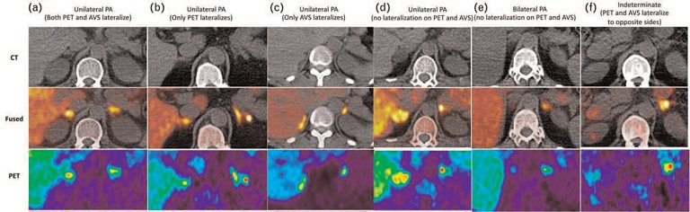 Terapia de dez minutos detecta e cura presso alta de origem gentica