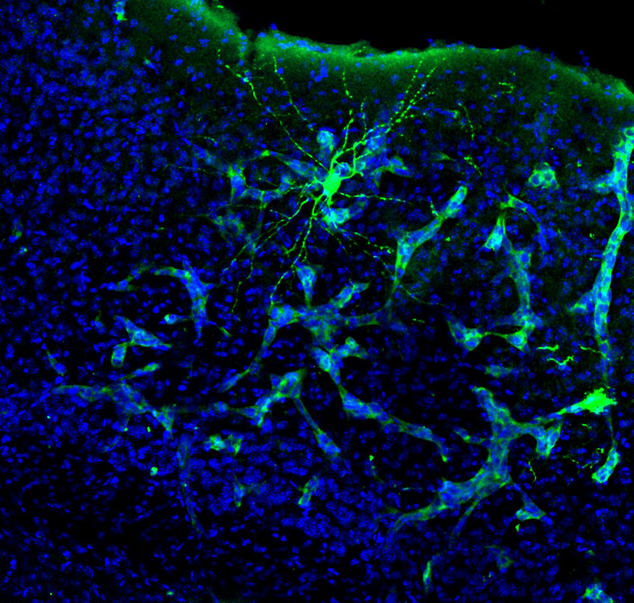 Tumores cerebrais hackeiam a comunicação entre os neurônios