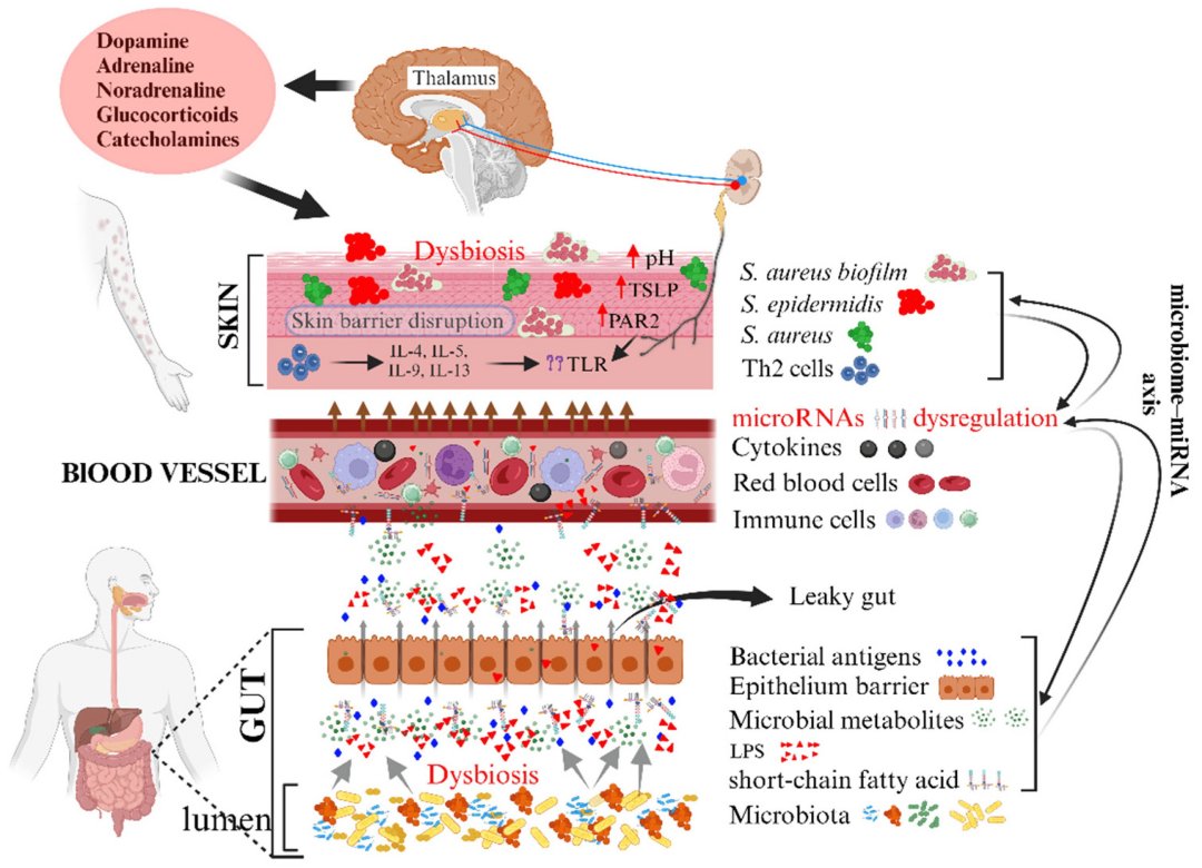 Conexão intestino-pele é fator central na dermatite atópica