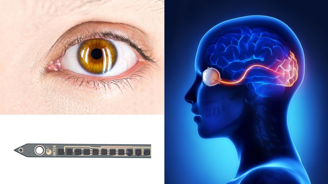 Implantes de viso chegam ao nvel da tecnologia atual