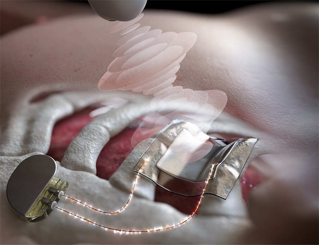 Recarregamento de bateria sem fio ultrassnico para implantes mdicos