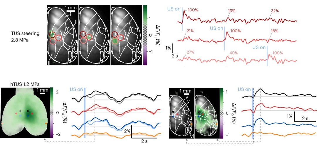 Hologramas de ultrassom vo tratar Alzheimer, Parkinson e muito mais