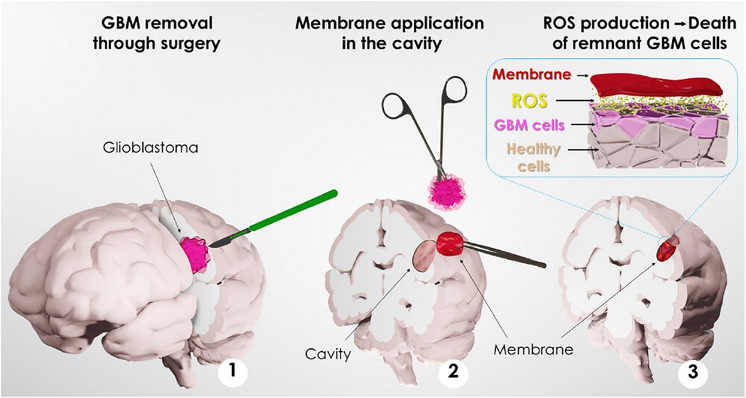 Adesivo inspirado nos mexilh�es traz esperan�a contra c�ncer cerebral