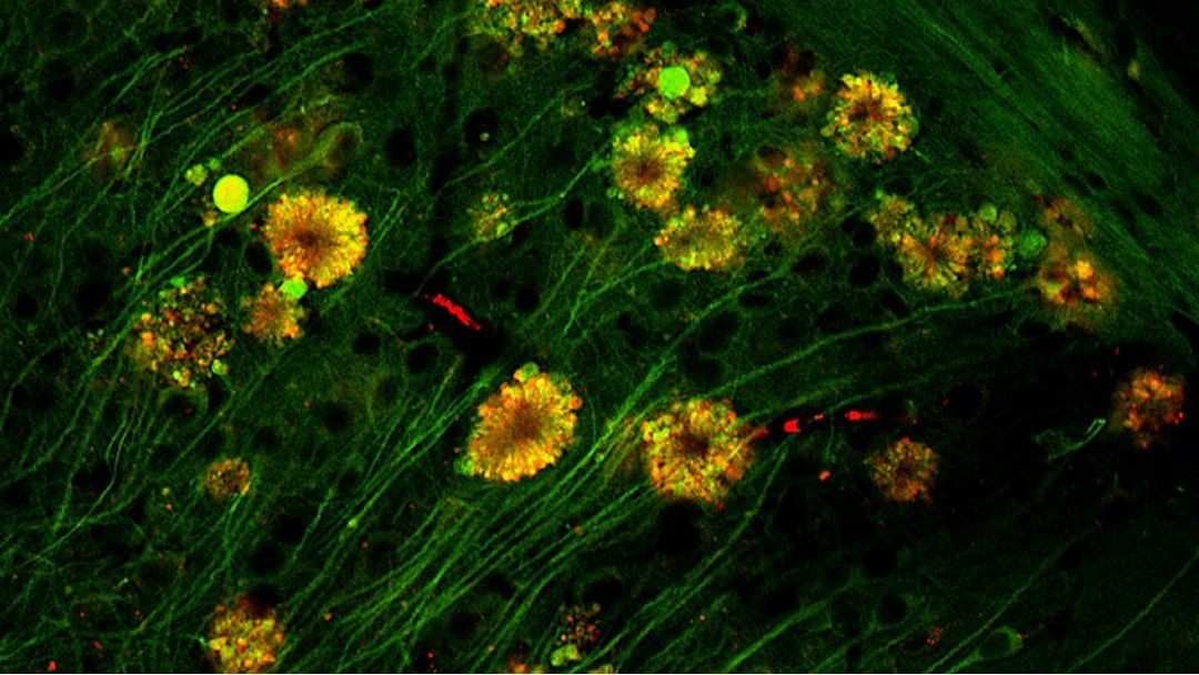 Alzheimer: N�o � aglomera��o de amiloides ou tau, � a competi��o entre elas