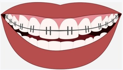 Aparelhos ortodnticos no aumentam bem-estar mais tarde na vida