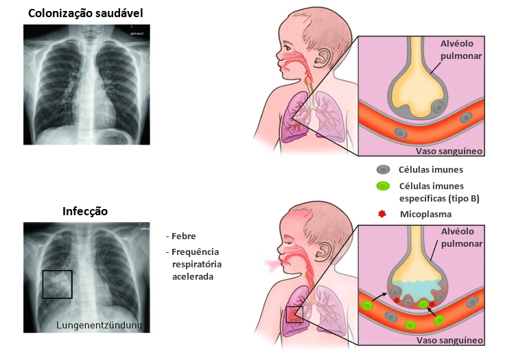 Pneumonia poder ser tratada com vacina em vez de antibiticos