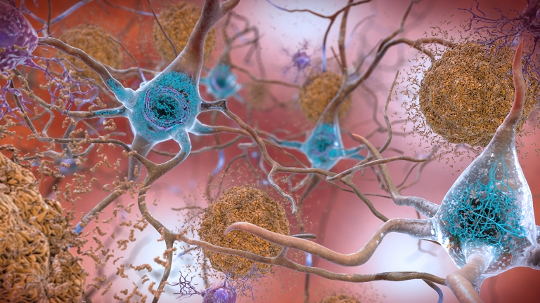 Alzheimer: P-tau indiciada, amiloide sob investigação