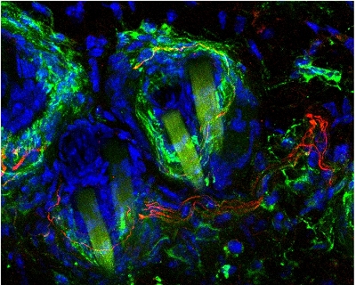 Primeira esperana de tratamento para a dor neuroptica