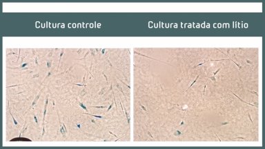 Ltio pode interromper a progresso da doena de Alzheimer?