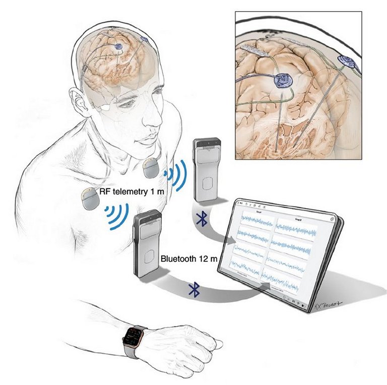 Gravaes de ondas cerebrais fazem tratamento individualizado de Parkinson