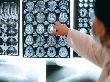 Inteligncia Artificial prev Alzheimer com quase 100% de preciso