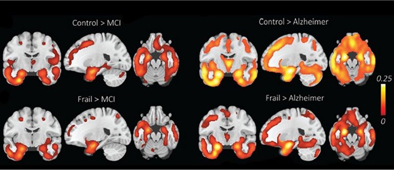 Declínio cognitivo nem sempre é sinal da doença de Alzheimer