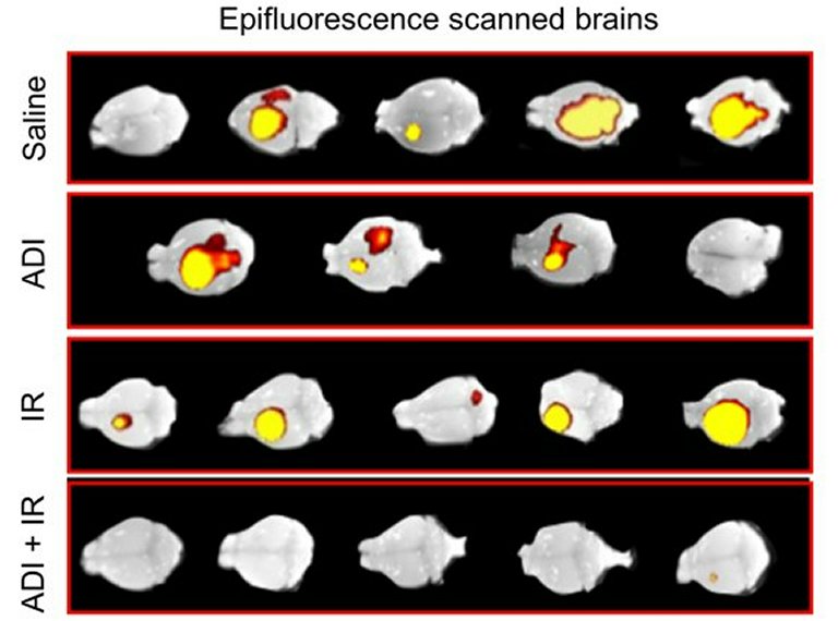 Terapia experimental elimina tumor cerebral hoje incurvel