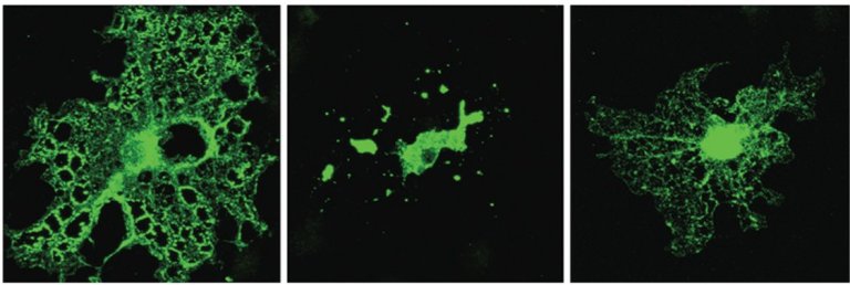 Pequenas partculas de colesterol bom podem proteger contra Alzheimer