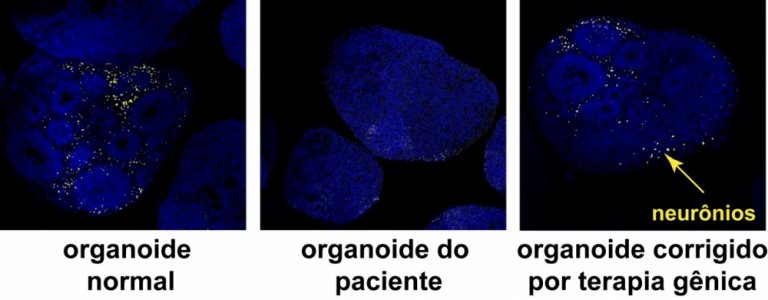 Rumo a uma terapia gnica para tratamento do autismo