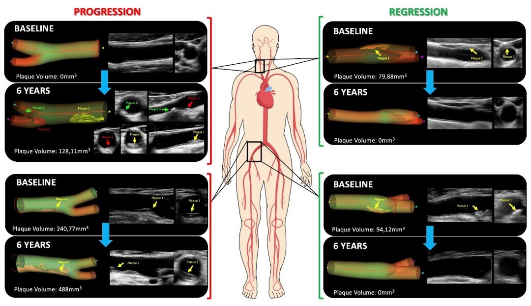 Jovens so mais vulnerveis aos fatores de risco cardiovascular