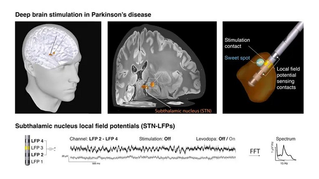 Descoberta nova assinatura cerebral da Doença de Parkinson