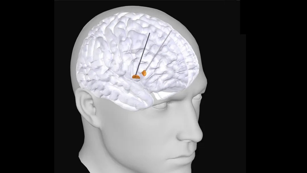 Descoberta nova assinatura cerebral da Doença de Parkinson