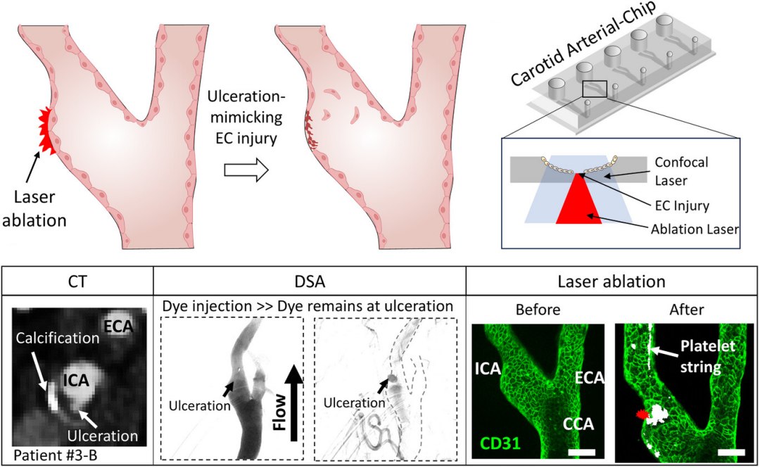 Art�ria em um chip: Vasos sangu�neos artificiais desvendam segredos dos AVCs