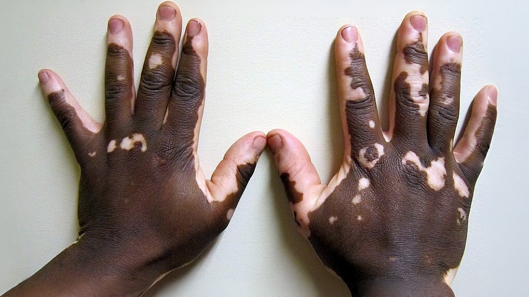 Vitiligo: Novas terapias prometem tratamento mais eficaz e duradouro