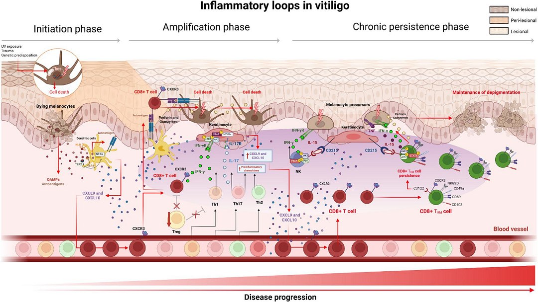 Vitiligo: Novas terapias prometem tratamento mais eficaz e duradouro