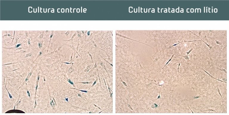 Ltio tem efeito benfico em pacientes com Alzheimer