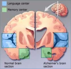 Vrus do herpes labial  ligado ao Mal de Alzheimer