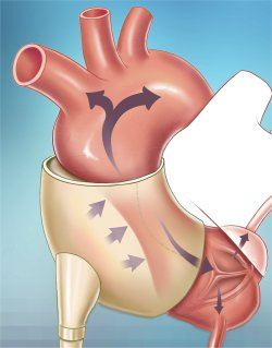 Implante na aorta ajuda no controle da insuficincia cardaca