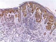 Teste genético distingue câncer de pele de mancha benigna