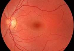 Terapia gênica restaura visão de portadores de cegueira genética
