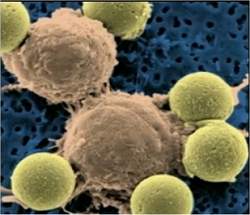 Células imunológicas modificadas geneticamente atacam leucemia