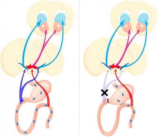 Cirurgia baritrica afeta hbito de ingerir acar