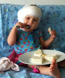 Implante tronco enceflico restaura audio de menina dois anos