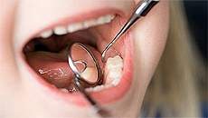 Erosão dentária aumenta entre crianças de 3 a 4 anos