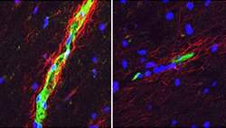 Proteína pode explicar porque esclerose múltipla afeta mais as mulheres