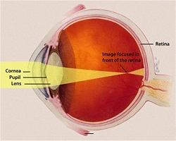 Lentes de contato especiais interrompem progresso da miopia