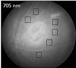 Alzheimer  detectado precocemente por exame da retina