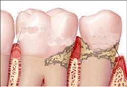 Cremes dental sem flúor não protege contra cáries e não evita fluorose