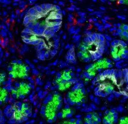 Incio do cncer de pncreas  interrompido em laboratrio