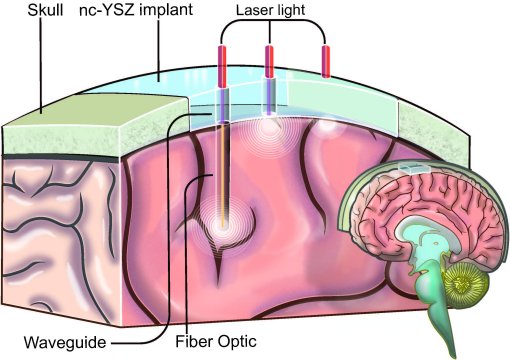 Implante craniano transparente permitir tratar crebro com luz